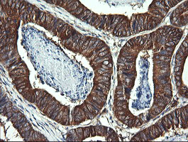 DNM1L / DRP1 Antibody - IHC of paraffin-embedded Carcinoma of Human pancreas tissue using anti-DNM1L mouse monoclonal antibody.