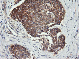 DNM1L / DRP1 Antibody - IHC of paraffin-embedded Carcinoma of Human lung tissue using anti-DNM1L mouse monoclonal antibody.