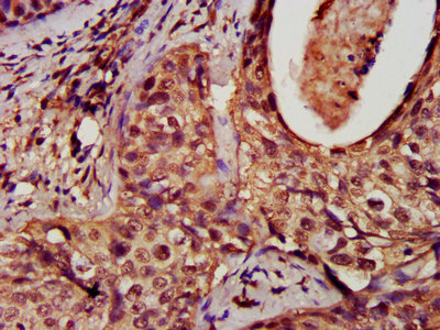 DNM1L / DRP1 Antibody - IHC image of DNM1L Antibody diluted at 1:50 and staining in paraffin-embedded human cervical cancer performed on a Leica BondTM system. After dewaxing and hydration, antigen retrieval was mediated by high pressure in a citrate buffer (pH 6.0). Section was blocked with 10% normal goat serum 30min at RT. Then primary antibody (1% BSA) was incubated at 4°C overnight. The primary is detected by a biotinylated secondary antibody and visualized using an HRP conjugated SP system.