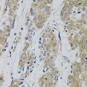 DNM2 / Dynamin-2 Antibody - Immunohistochemistry of paraffin-embedded human prostate cancer using DNM2 antibody(40x lens).