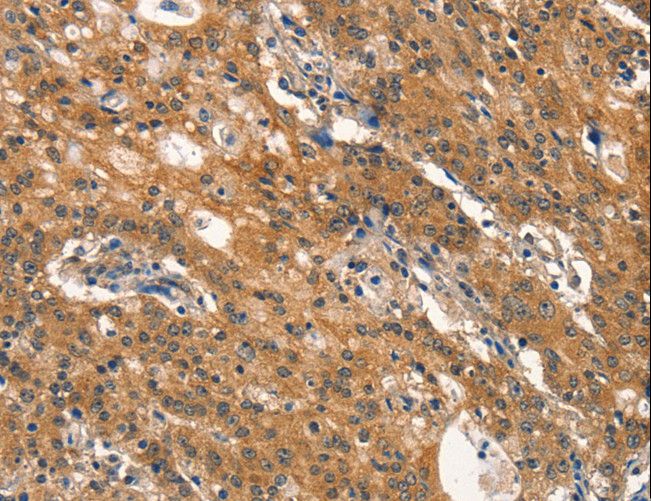 DNM2 / Dynamin-2 Antibody - Immunohistochemistry of paraffin-embedded Human gastric cancer using DNM2 Polyclonal Antibody at dilution of 1:40.
