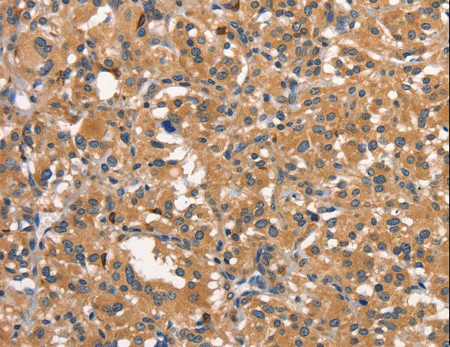 DNM2 / Dynamin-2 Antibody - Immunohistochemistry of paraffin-embedded Human thyroid cancer using DNM2 Polyclonal Antibody at dilution of 1:40.