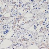 DNMT / DNMT1 Antibody - Immunohistochemistry of paraffin-embedded Human breast cancer using DNMT1 Polyclonal Antibody at dilution of 1:200 (40x lens).