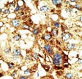 DNMT3A Antibody - Formalin-fixed and paraffin-embedded human cancer tissue reacted with the primary antibody, which was peroxidase-conjugated to the secondary antibody, followed by DAB staining. This data demonstrates the use of this antibody for immunohistochemistry; clinical relevance has not been evaluated. BC = breast carcinoma; HC = hepatocarcinoma.