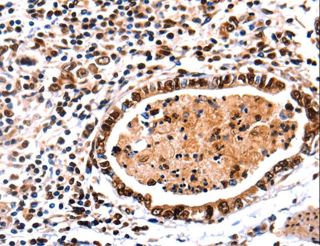 DNMT3A Antibody - Immunohistochemistry of paraffin-embedded Human stomach cancer using DNMT3A Polyclonal Antibody at dilution of 1:65.