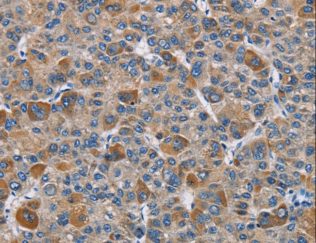 DNMT3A Antibody - Immunohistochemistry of paraffin-embedded Human thyroid cancer using DNMT3A Polyclonal Antibody at dilution of 1:50.