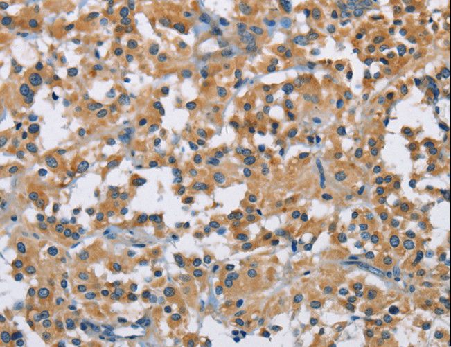 DNMT3A Antibody - Immunohistochemistry of paraffin-embedded Human thyroid cancer using DNMT3A Polyclonal Antibody at dilution of 1:50.