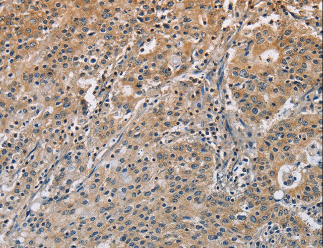 DNMT3A Antibody - Immunohistochemistry of paraffin-embedded Human gastric cancer using DNMT3A Polyclonal Antibody at dilution of 1:50.