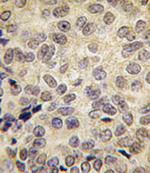 DNMT3B Antibody - Formalin-fixed and paraffin-embedded human prostate carcinoma tissue reacted with Dnmt3b antibody , which was peroxidase-conjugated to the secondary antibody, followed by DAB staining. This data demonstrates the use of this antibody for immunohistochemistry; clinical relevance has not been evaluated.