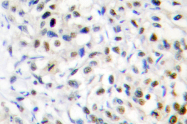 DNMT3B Antibody - IHC of Dnmt3b (H7) pAb in paraffin-embedded human liver carcinoma tissue.