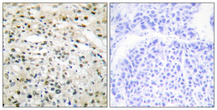 DNMT3B Antibody - Peptide - + Immunohistochemistry analysis of paraffin-embedded human liver carcinoma tissue using DNMT3B antibody.