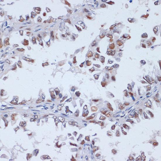 DNMT3L Antibody - Immunohistochemistry of paraffin-embedded Human lung cancer using DNMT3L Polyclonal Antibody at dilution of 1:100 (40x lens).