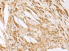 DNPEP Antibody - Immunohistochemistry of paraffin-embedded Human thyroid cancer tissue  using DNPEP Polyclonal Antibody at dilution of 1:60(×200)