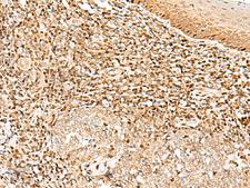 DNPEP Antibody - Immunohistochemistry of paraffin-embedded Human tonsil tissue  using DNPEP Polyclonal Antibody at dilution of 1:30(×200)