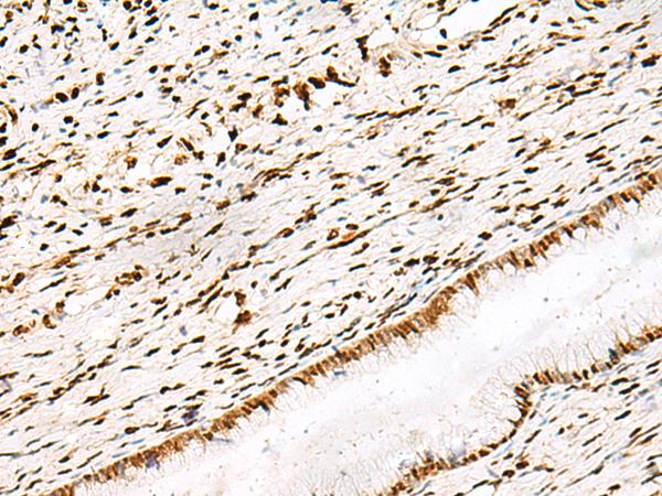 DNPEP Antibody - Immunohistochemistry of paraffin-embedded Human cervical cancer tissue  using DNPEP Polyclonal Antibody at dilution of 1:30(×200)