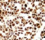 DNTT / TdT Antibody - IHC of TdT on FFPE Acute Lymphoblastic Lymphoma tissue. This image was taken for the unmodified form of this product. Other forms have not been tested.