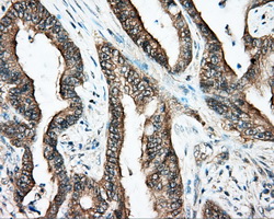 DNTTIP1 / TDIF1 Antibody - Immunohistochemical staining of paraffin-embedded Adenocarcinoma of colon tissue using anti-DNTTIP1 mouse monoclonal antibody. (Dilution 1:50).