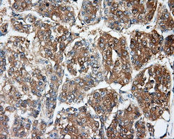 DNTTIP1 / TDIF1 Antibody - Immunohistochemical staining of paraffin-embedded Carcinoma of liver tissue using anti-DNTTIP1 mouse monoclonal antibody. (Dilution 1:50).