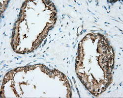 DNTTIP1 / TDIF1 Antibody - Immunohistochemical staining of paraffin-embedded Carcinoma of prostate tissue using anti-DNTTIP1 mouse monoclonal antibody. (Dilution 1:50).