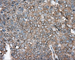 DNTTIP1 / TDIF1 Antibody - Immunohistochemical staining of paraffin-embedded Adenocarcinoma of ovary tissue using anti-DNTTIP1 mouse monoclonal antibody. (Dilution 1:50).