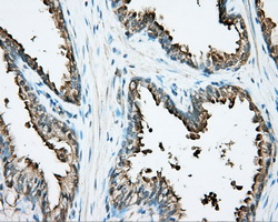 DNTTIP1 / TDIF1 Antibody - Immunohistochemical staining of paraffin-embedded Carcinoma of prostate tissue using anti-DNTTIP1 mouse monoclonal antibody. (Dilution 1:50).