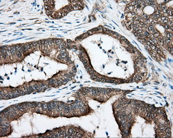 DNTTIP1 / TDIF1 Antibody - Immunohistochemical staining of paraffin-embedded Adenocarcinoma of colon tissue using anti-DNTTIP1 mouse monoclonal antibody. (Dilution 1:50).
