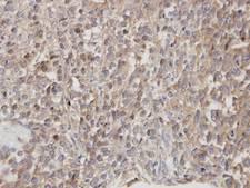 DOCK180 / DOCK1 Antibody - IHC of paraffin-embedded Lung CA using DOCK 180 antibody at 1:100 dilution.