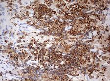 DOCK2 Antibody - IHC of paraffin-embedded Carcinoma of Human lung tissue using anti-DOCK2 mouse monoclonal antibody. (Heat-induced epitope retrieval by 1 mM EDTA in 10mM Tris, pH8.5, 120°C for 3min).