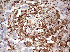 DOCK2 Antibody - IHC of paraffin-embedded Adenocarcinoma of Human ovary tissue using anti-DOCK2 mouse monoclonal antibody. (Heat-induced epitope retrieval by 1 mM EDTA in 10mM Tris, pH8.5, 120°C for 3min).