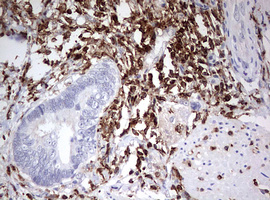 DOCK2 Antibody - IHC of paraffin-embedded Adenocarcinoma of Human colon tissue using anti-DOCK2 mouse monoclonal antibody. (Heat-induced epitope retrieval by 10mM citric buffer, pH6.0, 120°C for 3min).