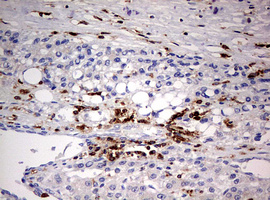 DOCK2 Antibody - IHC of paraffin-embedded Carcinoma of Human liver tissue using anti-DOCK2 mouse monoclonal antibody. (Heat-induced epitope retrieval by 10mM citric buffer, pH6.0, 120°C for 3min).