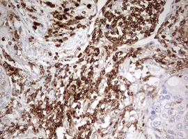 DOCK2 Antibody - IHC of paraffin-embedded Carcinoma of Human lung tissue using anti-DOCK2 mouse monoclonal antibody. (Heat-induced epitope retrieval by 10mM citric buffer, pH6.0, 120°C for 3min).