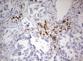 DOCK2 Antibody - IHC of paraffin-embedded Carcinoma of Human pancreas tissue using anti-DOCK2 mouse monoclonal antibody. (Heat-induced epitope retrieval by 10mM citric buffer, pH6.0, 120°C for 3min).