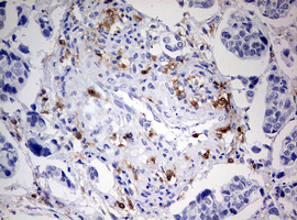 DOCK2 Antibody - IHC of paraffin-embedded Carcinoma of Human bladder tissue using anti-DOCK2 mouse monoclonal antibody. (Heat-induced epitope retrieval by 10mM citric buffer, pH6.0, 120°C for 3min).