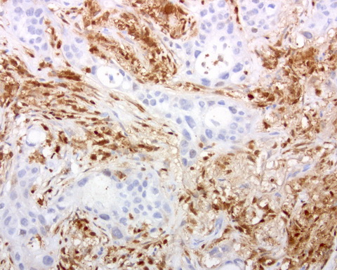 DOCK2 Antibody - Immunohistochemical staining of paraffin-embedded human lung cancer using anti-DOCK2 clone UMAB142 mouse monoclonal antibody at 1:200 dilution of 1.0 mg/mL using Polink2 Broad HRP DAB for detection.requires HIER with with citrate pH6.0 at 110C for 3 min using pressure chamber/cooker. IHC staining shows tumor cells are negative however infiltrating lymphocytes strongly positive.