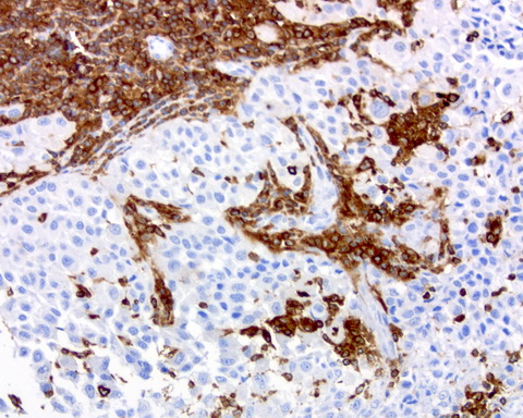 DOCK2 Antibody - Immunohistochemical staining of paraffin-embedded human melanoma using anti-DOCK2 clone UMAB142 mouse monoclonal antibody at 1:200 dilution of 1.0 mg/mL using Polink2 Broad HRP DAB for detection.requires HIER with with citrate pH6.0 at 110C for 3 min using pressure chamber/cooker. IHC staining shows tumor cells are negative however infiltrating lymphocytes strongly positive.