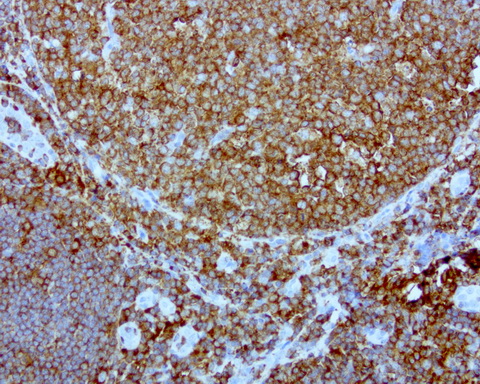 DOCK2 Antibody - Immunohistochemical staining of paraffin-embedded human tonsil using anti-DOCK2 clone UMAB142 mouse monoclonal antibody at 1:200 dilution of 1.0 mg/mL using Polink2 Broad HRP DAB for detection.requires HIER with with citrate pH6.0 at 110C for 3 min using pressure chamber/cooker. IHC staining shows germinal and nongerminal center with strong stain in the cytoplasm and membrane.