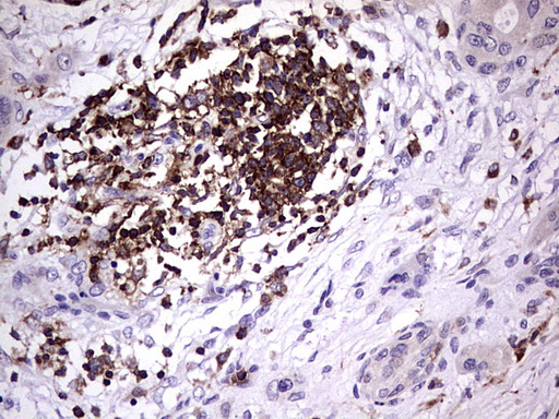 DOCK2 Antibody - Immunohistochemical staining of paraffin-embedded Carcinoma of Human pancreas tissue using anti-DOCK2 mouse monoclonal antibody.  heat-induced epitope retrieval by 1 mM EDTA in 10mM Tris, pH8.5, 120C for 3min)