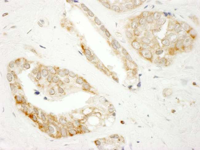 DOCK4 Antibody - Detection of Human DOCK4 by Immunohistochemistry. Sample: FFPE section of human prostate carcinoma. Antibody: Affinity purified rabbit anti-DOCK4 used at a dilution of 1:250.
