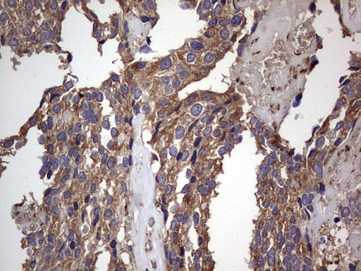 DOCK8 Antibody - IHC of paraffin-embedded Adenocarcinoma of Human breast tissue using anti-DOCK8 mouse monoclonal antibody. (Heat-induced epitope retrieval by 1 mM EDTA in 10mM Tris, pH8.5, 120°C for 3min).