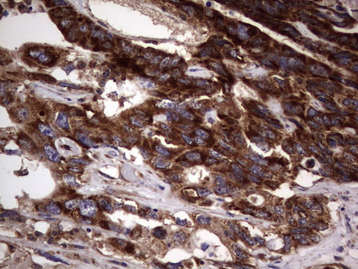 DOCK8 Antibody - IHC of paraffin-embedded Adenocarcinoma of Human colon tissue using anti-DOCK8 mouse monoclonal antibody. (Heat-induced epitope retrieval by 1 mM EDTA in 10mM Tris, pH8.5, 120°C for 3min).