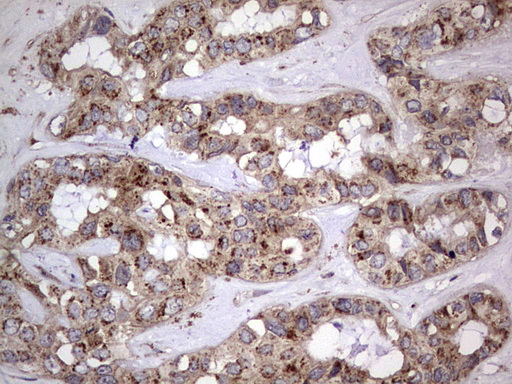 DOCK8 Antibody - IHC of paraffin-embedded Carcinoma of Human liver tissue using anti-DOCK8 mouse monoclonal antibody. (Heat-induced epitope retrieval by 1 mM EDTA in 10mM Tris, pH8.5, 120°C for 3min).