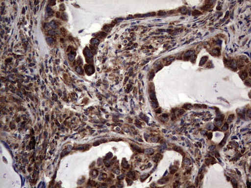 DOCK8 Antibody - IHC of paraffin-embedded Carcinoma of Human lung tissue using anti-DOCK8 mouse monoclonal antibody. (Heat-induced epitope retrieval by 1 mM EDTA in 10mM Tris, pH8.5, 120°C for 3min).