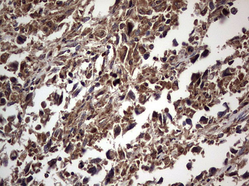 DOCK8 Antibody - IHC of paraffin-embedded Adenocarcinoma of Human ovary tissue using anti-DOCK8 mouse monoclonal antibody. (Heat-induced epitope retrieval by 1 mM EDTA in 10mM Tris, pH8.5, 120°C for 3min).