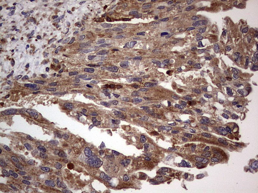DOCK8 Antibody - IHC of paraffin-embedded Carcinoma of Human pancreas tissue using anti-DOCK8 mouse monoclonal antibody. (Heat-induced epitope retrieval by 1 mM EDTA in 10mM Tris, pH8.5, 120°C for 3min).