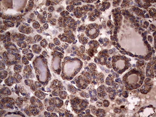 DOCK8 Antibody - IHC of paraffin-embedded Carcinoma of Human thyroid tissue using anti-DOCK8 mouse monoclonal antibody. (Heat-induced epitope retrieval by 1 mM EDTA in 10mM Tris, pH8.5, 120°C for 3min).