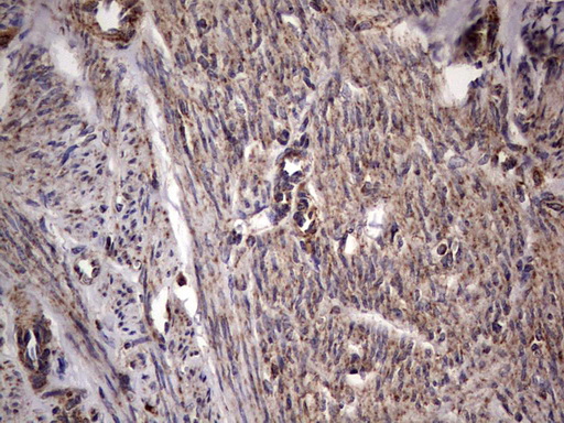DOCK8 Antibody - IHC of paraffin-embedded Adenocarcinoma of Human endometrium tissue using anti-DOCK8 mouse monoclonal antibody. (Heat-induced epitope retrieval by 1 mM EDTA in 10mM Tris, pH8.5, 120°C for 3min).