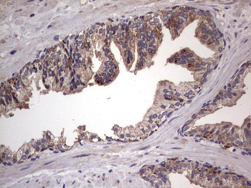 DOCK8 Antibody - IHC of paraffin-embedded Carcinoma of Human prostate tissue using anti-DOCK8 mouse monoclonal antibody. (Heat-induced epitope retrieval by 1 mM EDTA in 10mM Tris, pH8.5, 120°C for 3min).