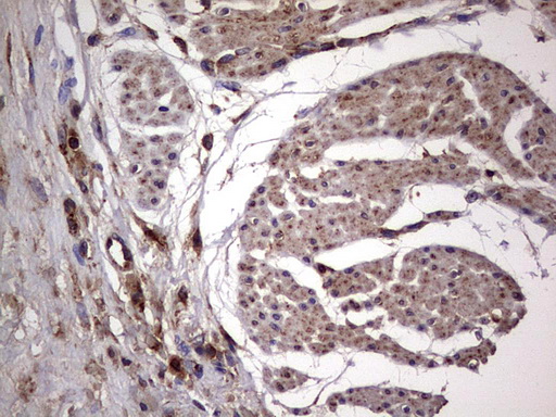 DOCK8 Antibody - IHC of paraffin-embedded Human bladder tissue using anti-DOCK8 mouse monoclonal antibody. (Heat-induced epitope retrieval by 1 mM EDTA in 10mM Tris, pH8.5, 120°C for 3min).