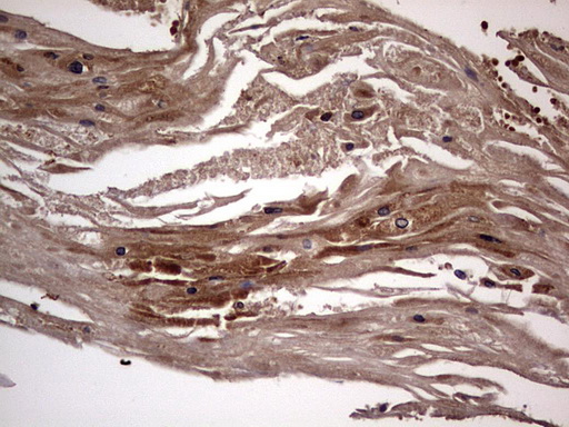 DOCK8 Antibody - IHC of paraffin-embedded Carcinoma of Human bladder tissue using anti-DOCK8 mouse monoclonal antibody. (Heat-induced epitope retrieval by 1 mM EDTA in 10mM Tris, pH8.5, 120°C for 3min).